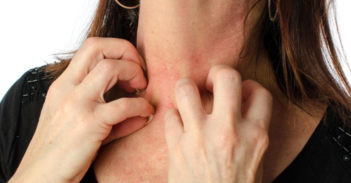 Best Essential Oils For Eczema