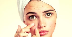 Essential Oils for Acne – Treat, Heal And Prevent Breakouts