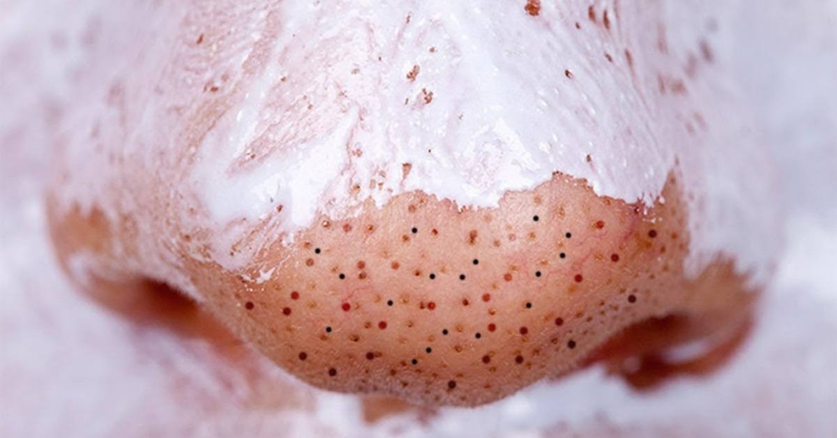 essential oils for blackheads