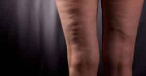 Essential Oils For Cellulite & How You Should Use Them Effectively!