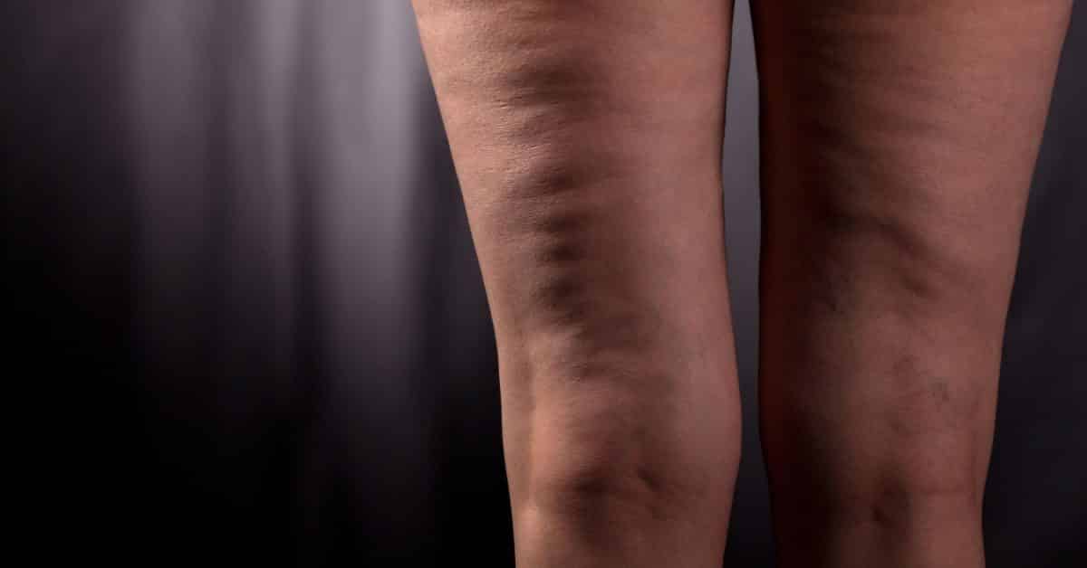 essential oils for cellulite