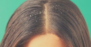 Use Essential Oils To Get Rid Of Dandruff (8 Oils +3 DIY Recipes)