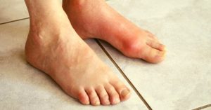 11 Essential Oils For Gout You Should Be Using (+Instructions)