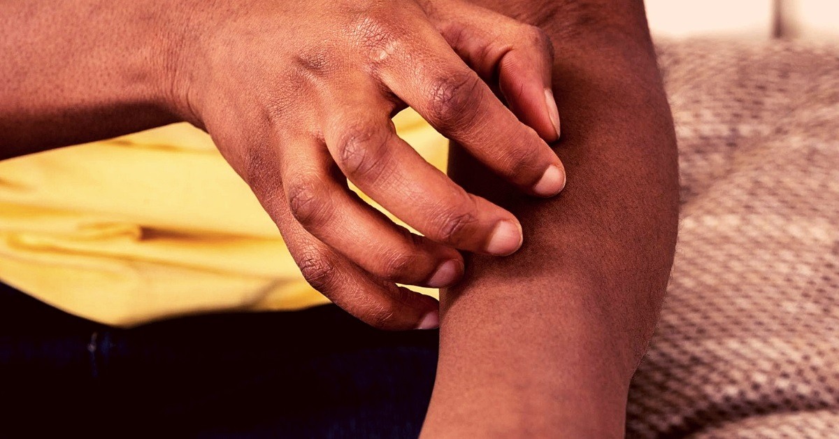essential oils for itching