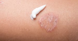 6 TOP Essential Oils for Psoriasis & 5 DIY Recipes To Try Now…