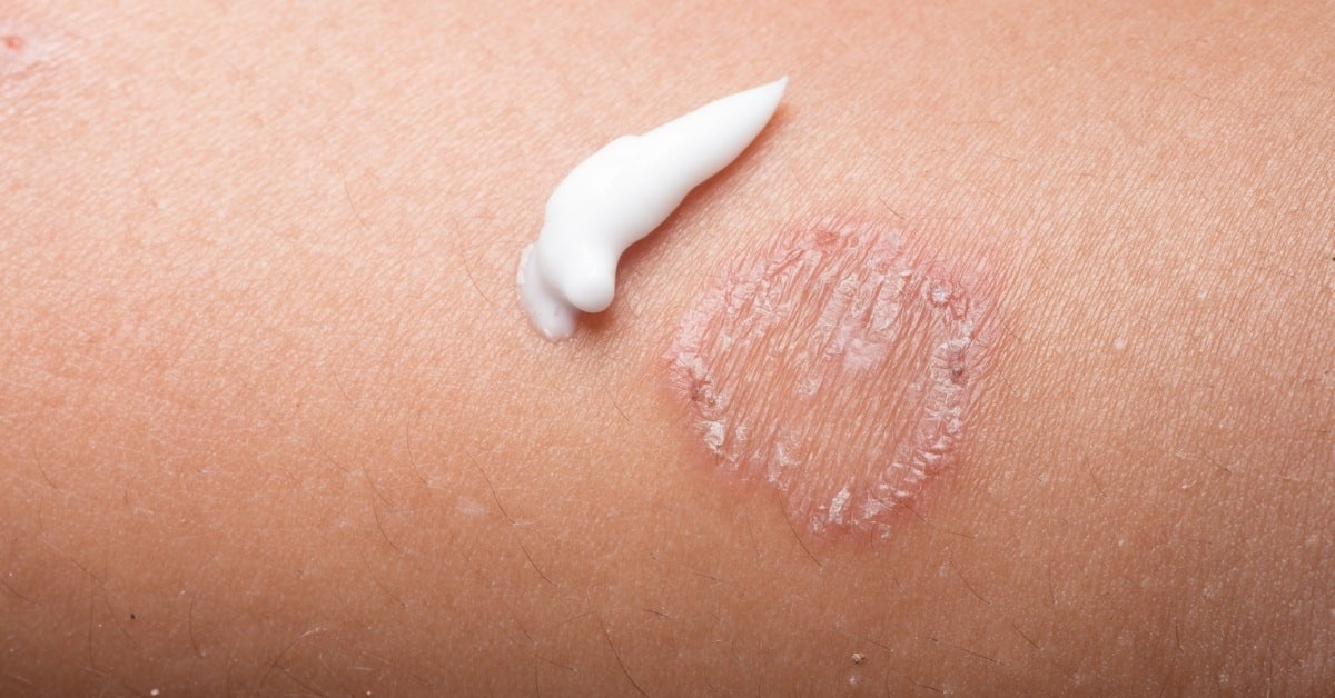 essential oils for psoriasis