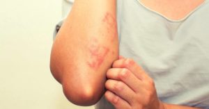 Best Essential Oils For Rashes (Types, When and How To Use Safely)