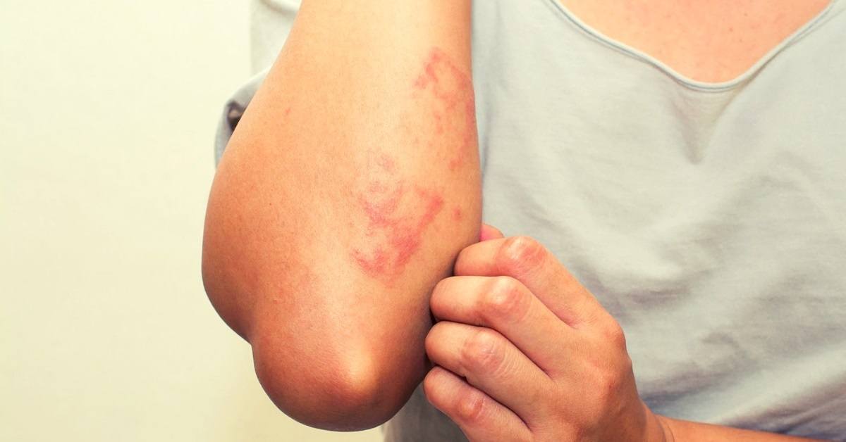 essential oils for rashes