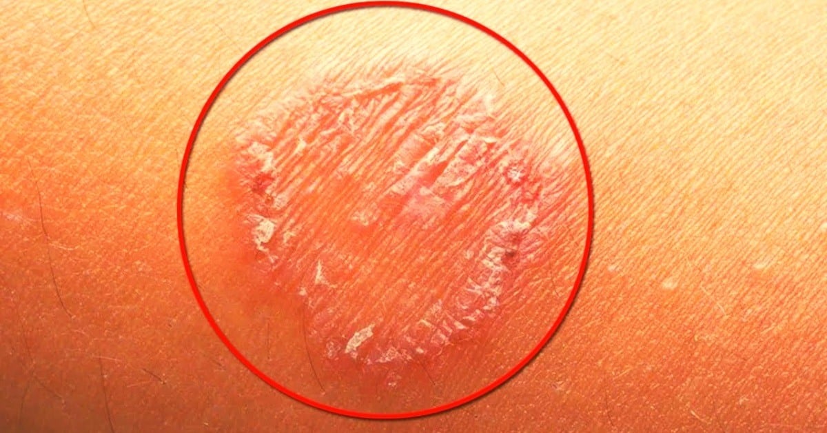 essential oils for ringworm