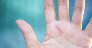Essential Oils for Scars (Best Oils For Each Type of Scar & How To Use!)