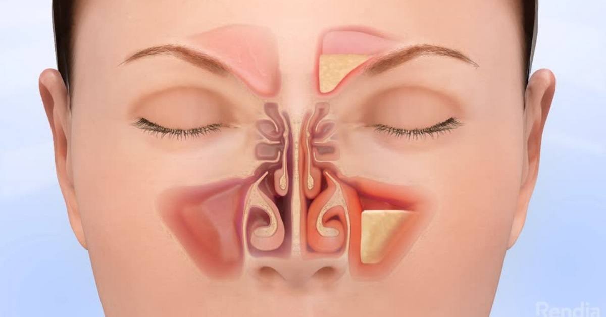 essential oils for sinus infection