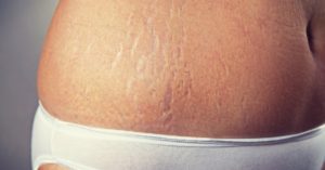 Best Essential Oils For Stretch Marks (+Recipes) To Make ‘Em Go Away!