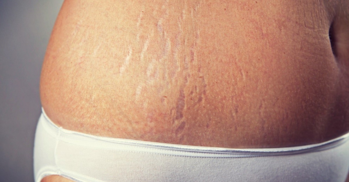 essential oils for stretch marks