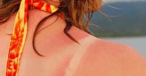Essential Oils For Sunburn – How To Stay Safe & Get Relief [Explained]