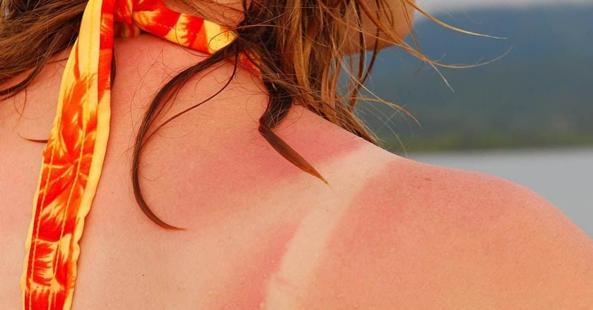 essential oils for sunburn