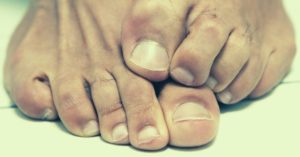 Essential Oils for Toenail Fungus – Top 8 + 3 Powerful Recipes To Try!