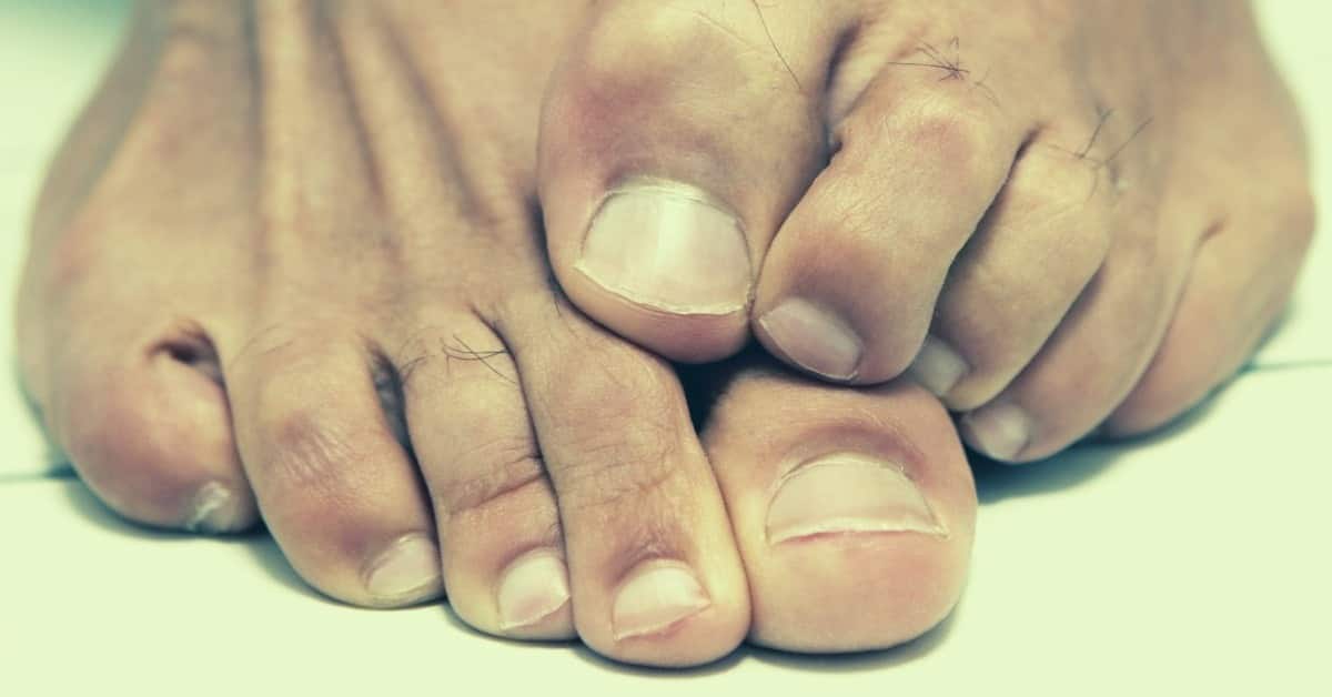 essential oils for toenail fungus