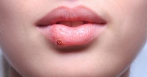 8 Best Essential Oils For Herpes & Which To Use When (+ 3 Antiviral Recipes!)